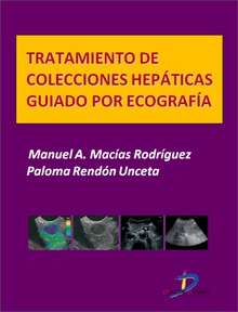 Tratamiento de colecciones hepáticas guiado por ecografía