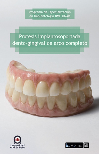 Prótesis implantosoportada dento-gingival de arco completo