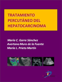 Tratamiento percutáneo del hepatocarcinoma